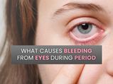 Red Tears - Woman Bleeds From The Eye During Her Periods! Know About The Rare Condition