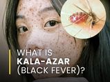 What Is Kala-Azar (Black Fever)? Causes, Symptoms, Risk Factors, Treatments And Prevention