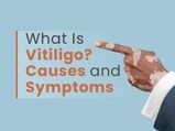 World Vitiligo Day 2021: What Is Vitiligo? Causes, Types, Symptoms, Complications And Treatment
