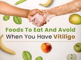World Vitiligo Day 2021: List Of Foods Which People With Vitiligo Should Eat And Avoid