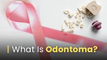 Doctors Remove 82 Teeth From Teenager Due To Rare Tumour Complex Odontoma, Know More