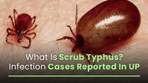 Scrub Typhus; Know About The Cause, Symptoms And Prevention Of The Mystery Fever Reported In UP