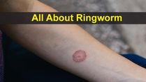All About Ringworm: Causes, Symptoms, Risk Factors, Diagnosis, Treatments And Prevention