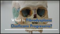 Fibrodysplasia Ossificans Progressiva: A Disease That Turns Flesh Into Bones