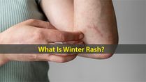 What Is Winter Rash? Causes, Symptoms, Risk Factors And Treatments