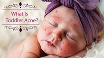 What Is Toddler Acne? Causes, Symptoms, Complications, Diagnosis And Treatments