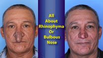 NY Man Treated For Rhinophyma Or Bulbous Nose: Causes, Symptoms And Treatment Of The Condition