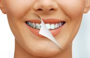 Expert Article: Teeth Aligners Promise Much More Than A Bollywood Smile!