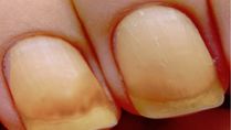 What Is Yellow Nail Syndrome? Causes, Symptoms, Complications, Diagnosis And Treatments