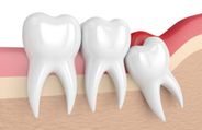 Expert Article: Wisdom Tooth Pain And Why Is Wisdom Tooth Removal So Common?