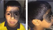 What Is Congenital Melanocytic Nevus, A Rare Birthmark? Causes, Symptoms, Complications And Treatments