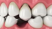Expert Article On Loose Teeth: When Should You Be Worried About Your Shaky Teeth?
