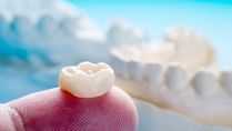 Expert Article: Did Your Dental Crown Fall Out? Here Are Some Remedies