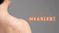 Measles Outbreak In Mumbai: Know About The Disease, Its Causes, Symptoms, Treatment And Prevention