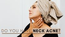 Do You Have Neck Acne? Here's How You Can Get Rid Of It!