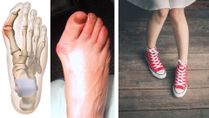 Does Your Shoes Actually Give You Bunions Or Bony Lumps?