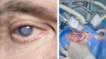 Cataract Surgery: Types, Pros And Cons; Expert Explains Everything You Need To Know