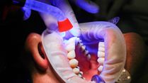 From Gaps To Grins: What You Need To Know About Dental Implants