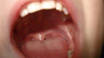Bad Taste In Mouth: How To Fix It, Why It Indicates Multiple Health Problems