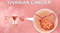 Ovarian Cancer Day: Know About The Warning Signs; Are Women Over 30 At Risk?