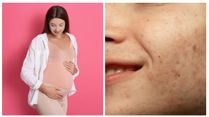 What Is Pregnancy Mask (Melasma): Ways To Manage It