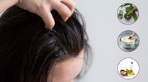Best 5 Home Remedies For Forehead Dandruff
