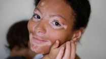World Vitiligo Day 2023: Are You At Risk Of Developing Vitiligo?