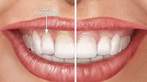 Expert Tips to Spot Your Gum Disease Early