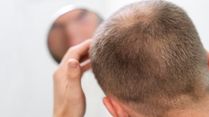 Is Early Balding In Men A Sign Of This Cancer?