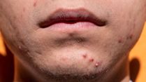 When Is It Time To Get Medical Treatment For Acne And Pimples?
