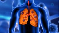 How Poor Oral Health Can Lead to Fatal Lung Disease Like Pneumonia, 6 Facts You Need To Know