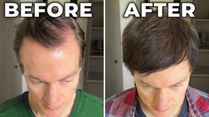 Is It Possible To Turn Back the Clock On Hair Loss And Greying? This 47-Year-Old Biohacker Says Yes