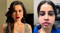 Uorfi Javed Got Her Lip Filler Dissolved? What No One Tells You Before That First Injection, Warning Signs!