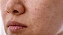The Skin Barrier Crisis: Is Your Skincare Routine Damaging Your Skin?