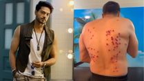 Gaurav Khanna Reveals Painful Laser Burn Marks From Khatron Ke Khiladi 15