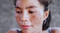Melasma, Tanning, Early Wrinkles: Expert Explains How Daily Sun Exposure Quietly Ages Your Skin