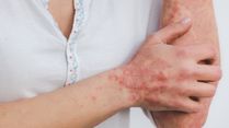 Why Stress Can Make Psoriasis Flare And Why Scratching Makes It Worse