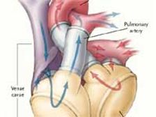 ‘లబ్ డబ్’ ధ్వని కూడా చేయని గుండె!