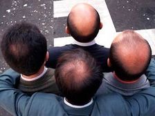 నూనె రాసుకోపోతే ‘బట్టతలే’..?