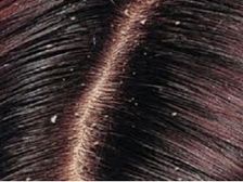 డాండ్రఫ్ (చుండ్రు)భారీ నుండి బయట పడటం ఎలా