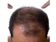 పురుషుల్లోనే బట్టతలకు కారణం..నివారణోపాయాలు...