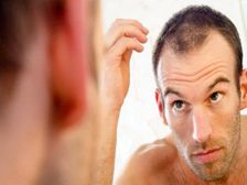 బట్టతల రాకుండా తీసుకోవలసిన జాగ్రత్తలు...