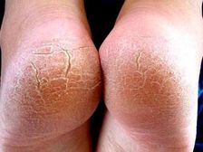 పాదాల పగుళ్ళకు కారణాలు..నివారణోపాయాలు