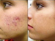 టీజేజ్ లో ముఖంపై రంధ్రాలు...?