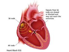 కార్డియో వాస్కులర్ డిసీజ్ అంటే? 