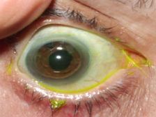 డయాబెటీస్ రోగుల కంటి శుక్లాలు!