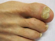 కాలి గోళ్ళులో ఫంగస్ నివారించడానికి ఉత్తమ హోం రెమెడీస్ 