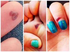 రక్తపు బొబ్బలు వదిలించుకునేందుకు 8 మార్గాలు !! 