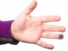 రక్తం బొబ్బలు కట్టకుండా ఉండడానికి 10 గృహ వైద్యాలు 