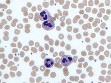 తెల్ల రక్తకణాలు హెచ్చు స్థాయిలో  ఉంటే ఏమి జరుగుతుంది?